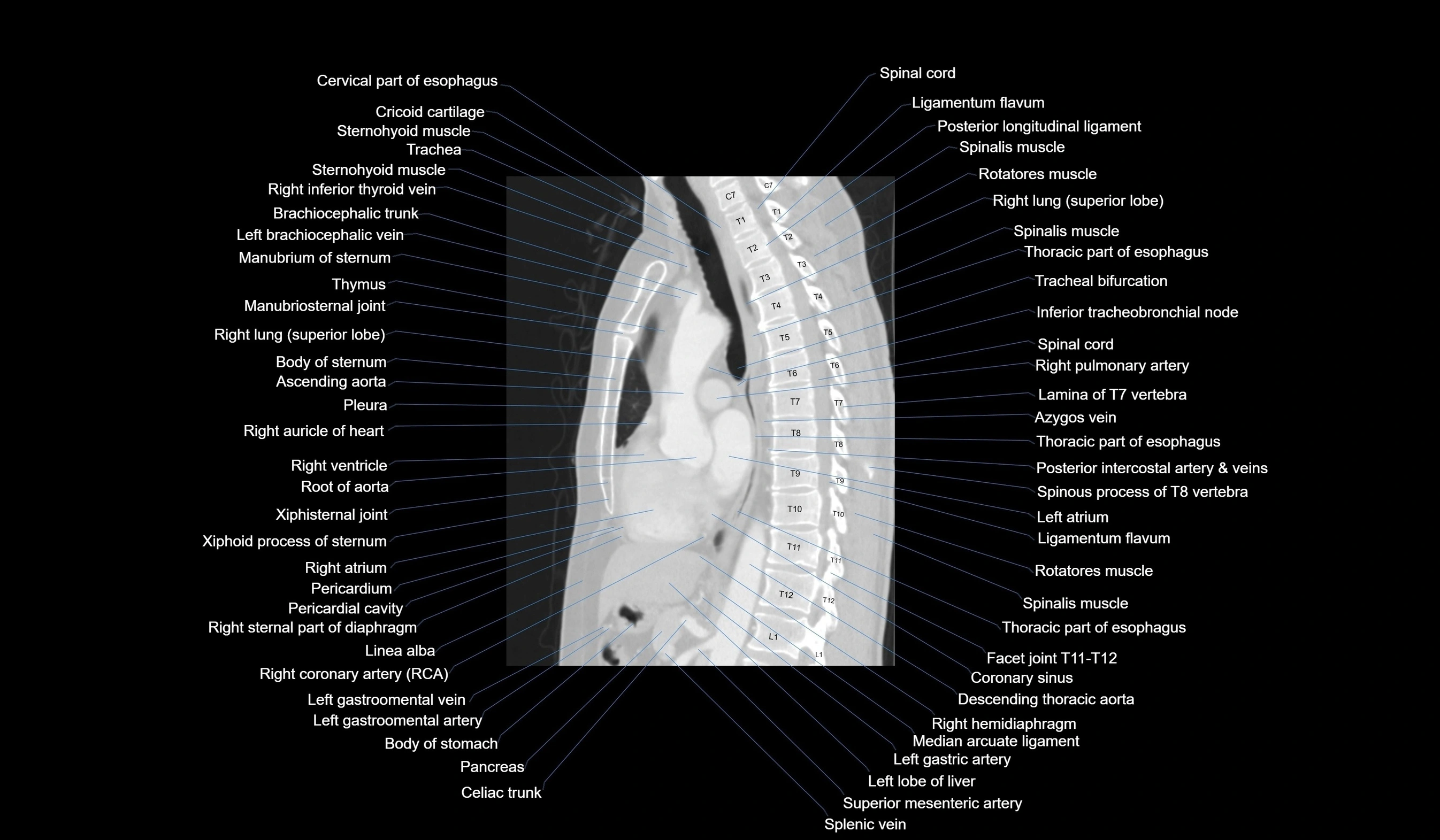 CT chest (thorax) lung window labelled sagittal cross sectional anatomy radiology image-00076.webp